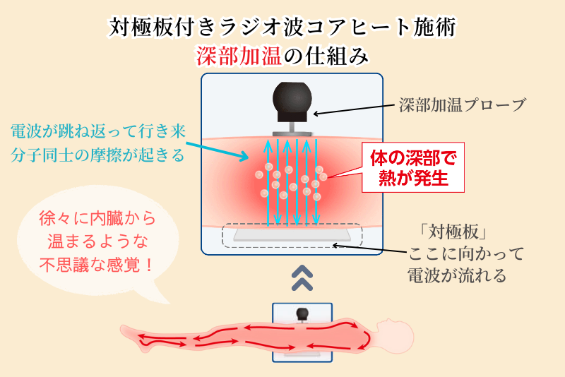 対極板付きラジオ波コアヒート施術深部加温の仕組み